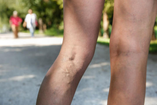 You are currently viewing Treating varicose veins