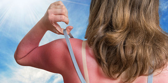Read more about the article When to see a doctor about your sunburn